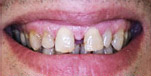 Cosmetic dentistry, Dentist Bangkok, Thailand