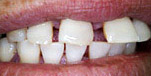Dental implant, Dentist Bangkok, Thailand