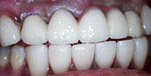 Dental implant, Dentist Bangkok, Thailand