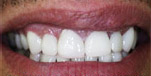 Cosmetic dentistry, Bangkok, Thailand